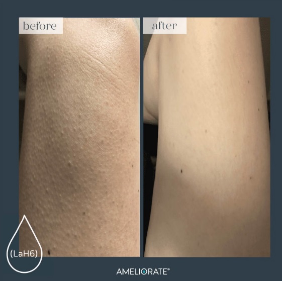 PRE-ORDER: AMELIORATE Transforming Body Lotion โลชั่นปรับสภาพผิว สำหรับผู้มีปัญหาผิวหนังไก่ ผิวไม่เรียบเนียน